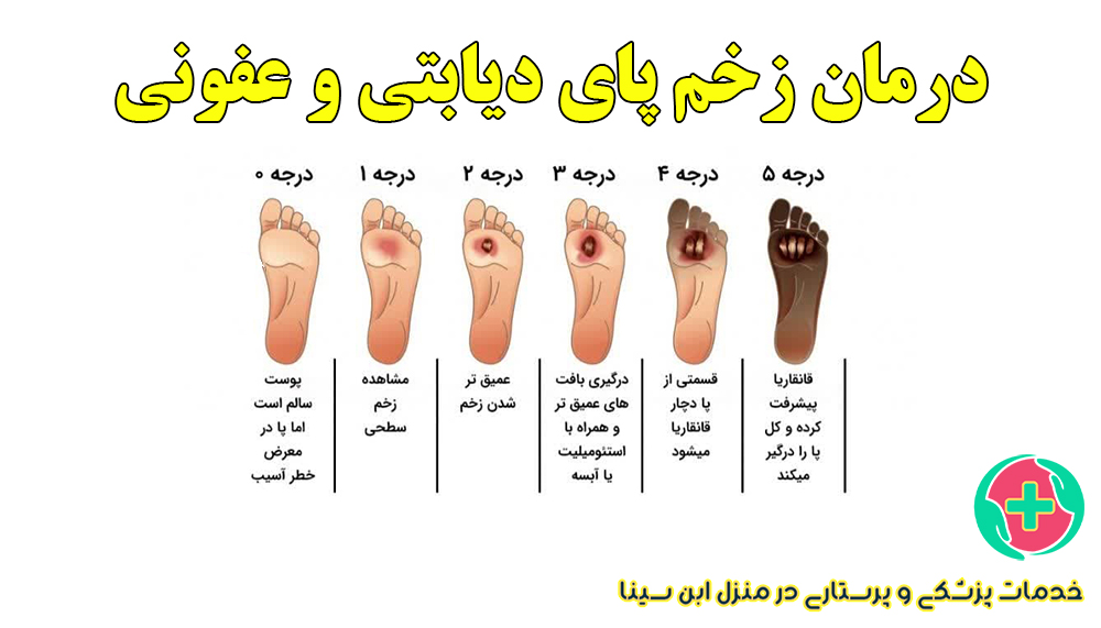 درمان زخم پای دیابتی و عفونی در منزل مشهد با تخصص کلینیک زخم ابن سینا