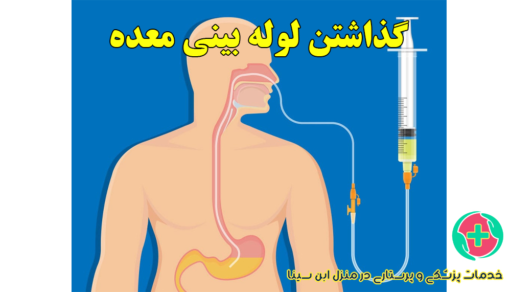 گذاشتن NG Tube سوند معده در منزل مشهد | مرکز ابن سینا