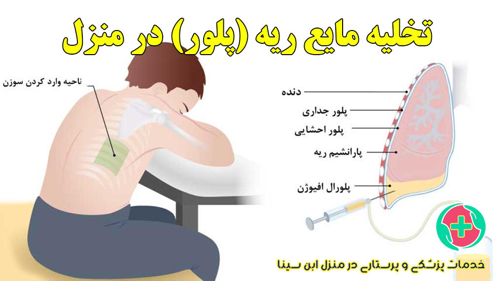 تخلیه مایع ریه (پلور) در منزل | مرکز شبانه روزی پرستاری ابن سینا در مشهد