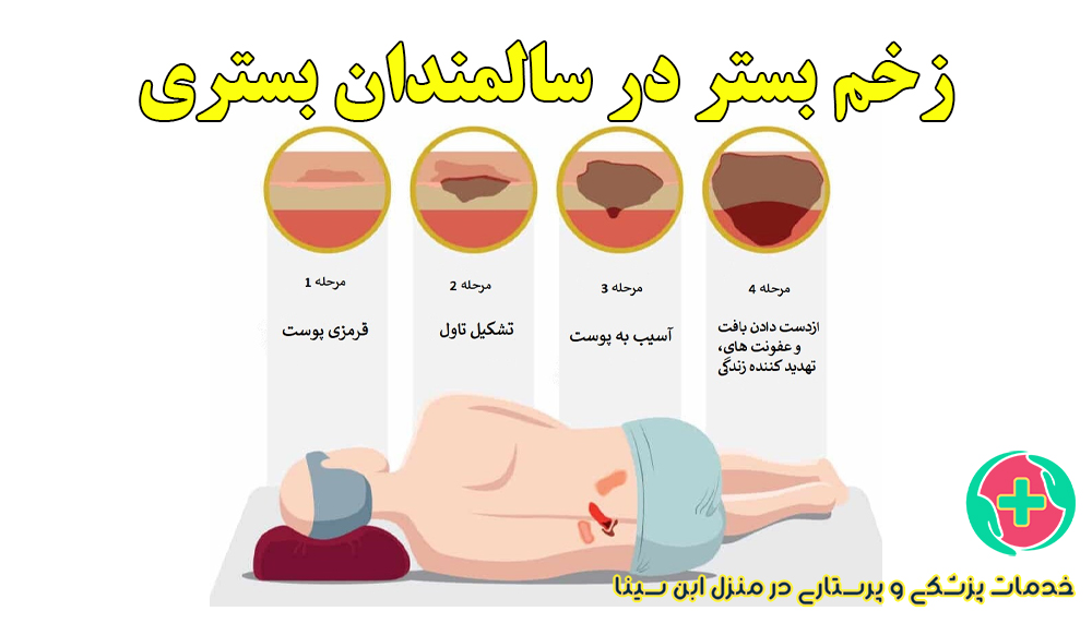 کنترل و پیشگیری از زخم بستر در سالمندان بستری | درمان زخم بستر در منزل