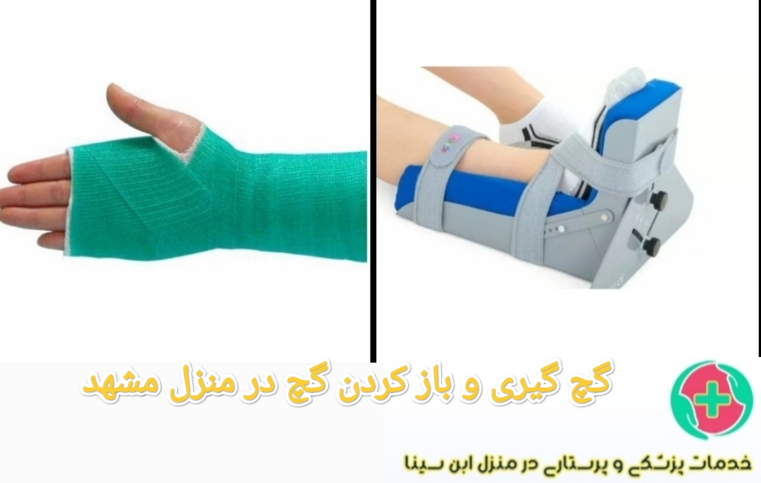 گچ گیری و باز کزدن گچ و آتل در منزل مشهد|آتل بندی در منزل مشهد