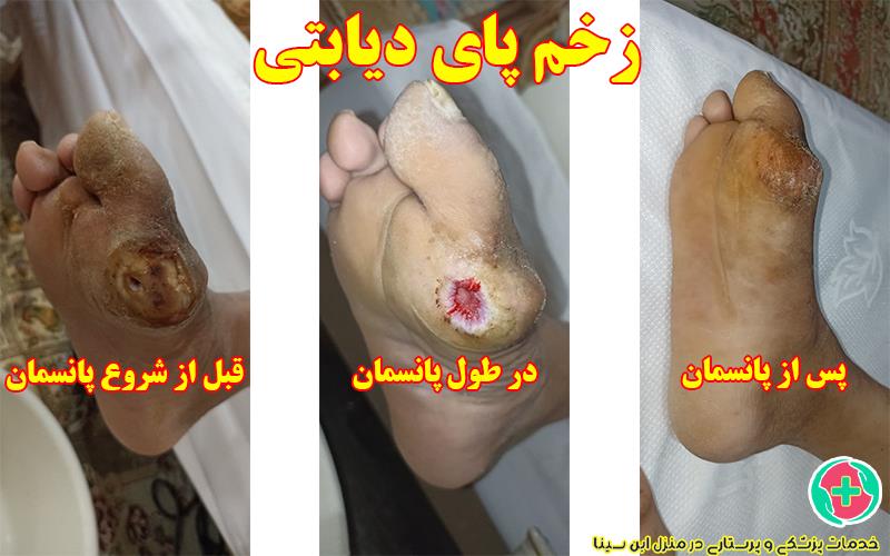 پانسمان زخم پای دیابتی در منزل