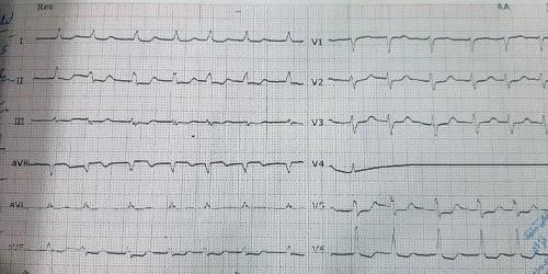عکس نوار قلب مریض