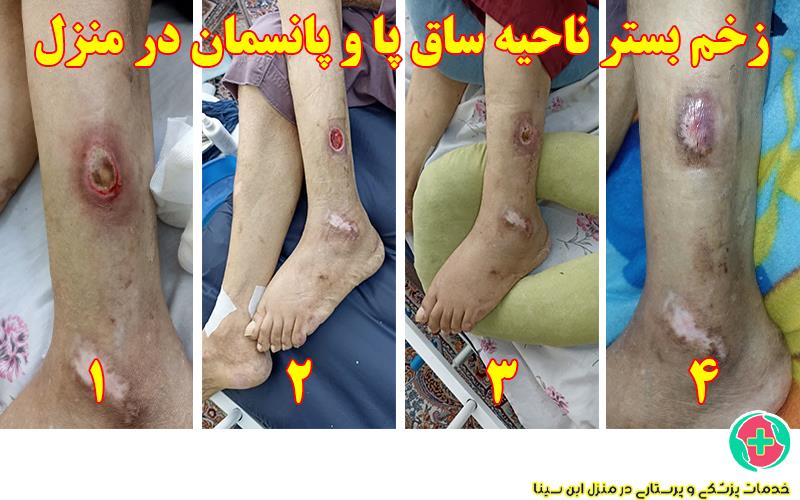 زخم بستر ناحیه ساق پا