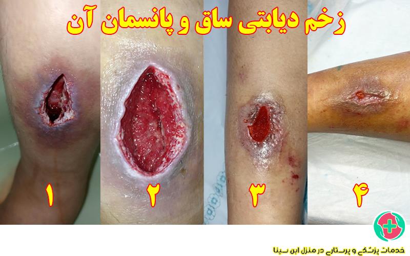 زخم دیابتی ساق و پانسمان آن