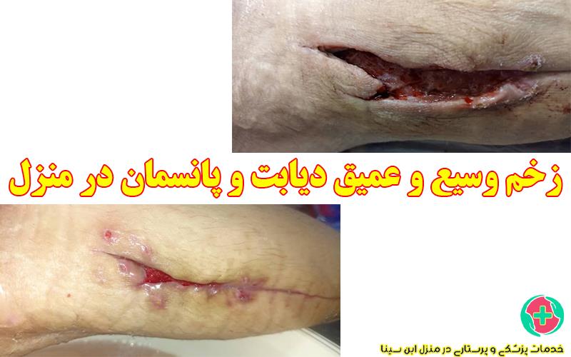 زخم دیابت