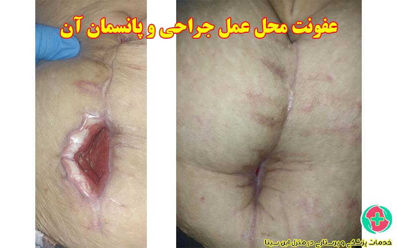 عفونت محل عمل جراحی